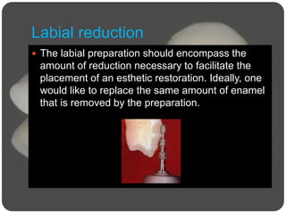 Labial reduction
 The labial preparation should encompass the
amount of reduction necessary to facilitate the
placement of an esthetic restoration. Ideally, one
would like to replace the same amount of enamel
that is removed by the preparation.
 