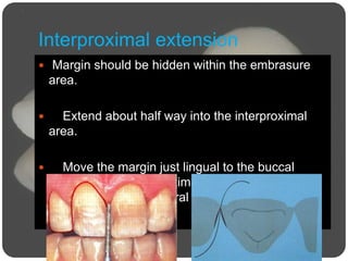 Interproximal extension
 Margin should be hidden within the embrasure
area.
 Extend about half way into the interproximal
area.
 Move the margin just lingual to the buccal
surface of the interproximal papillae so that it will
not be visible from lateral oblique view or directly
from the front.
 