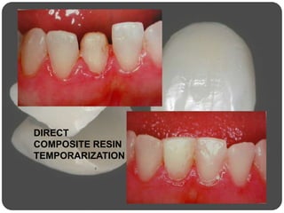 DIRECT
COMPOSITE RESIN
TEMPORARIZATION
 