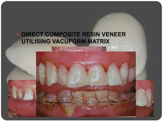  DIRECT COMPOSITE RESIN VENEER
UTILISING VACUFORM MATRIX
 