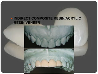  INDIRECT COMPOSITE RESIN/ACRYLIC
RESIN VENEER
 