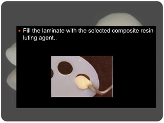  Fill the laminate with the selected composite resin
luting agent..
 