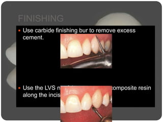 FINISHING
 Use carbide finishing bur to remove excess
cement.
 Use the LVS no. 8 bur to remove composite resin
along the incisal margin.
 