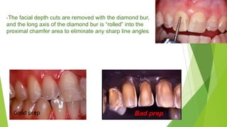 -The facial depth cuts are removed with the diamond bur,

and the long axis of the diamond bur is “rolled” into the
proxim...
