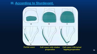24
III. According to Sturdevant.
Partial veneer Full veneer with window
preparation
Full veneer with incisal
lapping preparation:
 