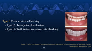 Magne P, Belser UC. Bonded Porcelain Restorations in the Anterior Dentition-a Biomimetic Approach. Chicago:
Quintessence Publishing Co; 2002.
26
Type I: Teeth resistant to bleaching
o Type IA: Tetracycline discoloration
o Type IB: Teeth that are unresponsive to bleaching
 