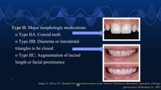Magne P, Belser UC. Bonded Porcelain Restorations in the Anterior Dentition-a Biomimetic Approach. Chicago:
Quintessence Publishing Co; 2002.
27
Type II: Major morphologic modications
o Type IIA: Conoid teeth
o Type IIB: Diastema or interdental
triangles to be closed
o Type IIC: Augmentation of incisal
length or facial prominence
.
 