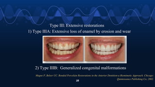 Magne P, Belser UC. Bonded Porcelain Restorations in the Anterior Dentition-a Biomimetic Approach. Chicago:
Quintessence Publishing Co; 2002.
28
Type III: Extensive restorations
1) Type IIIA: Extensive loss of enamel by erosion and wear
2) Type IIIB: Generalized congenital malformations
 