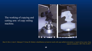68
The working of copying and
cutting arm of copy miling
machine.
Rani S, Devi J, Jain C, Mutneja P, Verma M. Esthetic rehabilitation of anterior teeth with copy-milled restorations: a report of two cases. Case
reports in dentistry. 2017 Feb 23;2017.
 