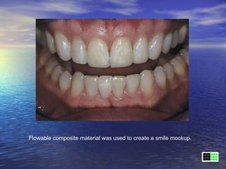 Flowable composite material was used to create a smile mockup.
 