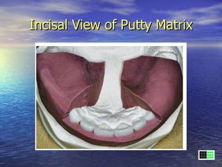 Incisal View of Putty Matrix
 