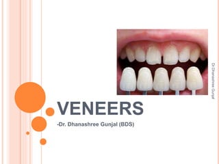 VENEERS
-Dr. Dhanashree Gunjal (BDS)
Dr.Dhanashree
Gunjal
 