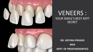 VENEERS :
YOUR SMILE’S BEST KEPT
SECRET
DR. SATVIKA PRASAD
MDS
DEPT. OF PROSTHODONTICS
 