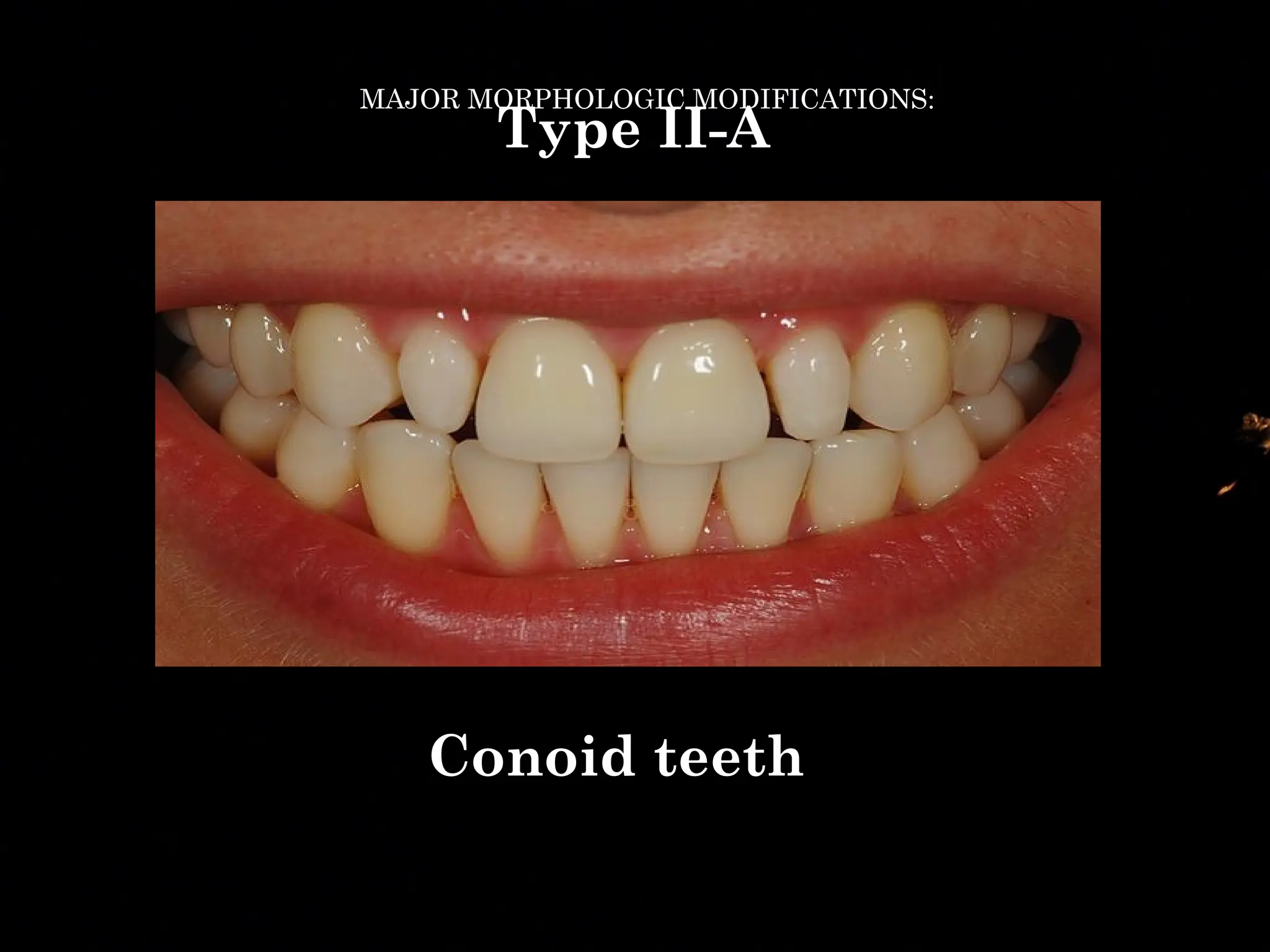 Veneers in conservative dentistry and endodontics | PPTX