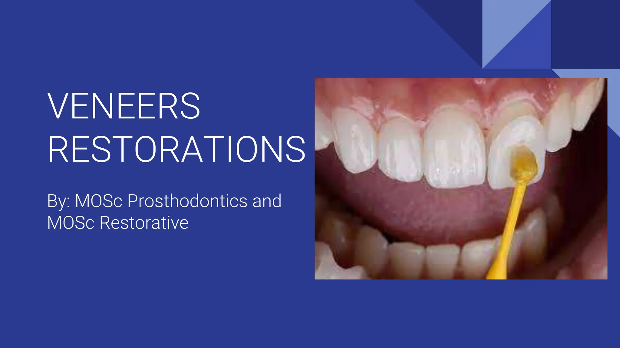 VENEERS RESTORATIONS definition,case selection & assessment PPT