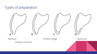 Window Feather-edge Butt joint
Palatal chamfer
Types of preparation
 
