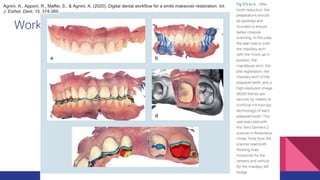 Workflow for Digital Impression
Agnini, A., Apponi, R., Maffei, S., & Agnini, A. (2020). Digital dental workflow for a smile makeover restoration. Int.
J. Esthet. Dent, 15, 374-389.
 