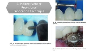 2. Indirect Veneer
Provisional
Fabrication Technique
 