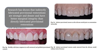 • Advantages of using a silicone
model of the preps are faster set of
the model as compared to a stone
cast, and flexibility of the silicone
model allows for easier removal of
the provisional veneers with less
risk of breakage
Research has shown that indirectly
fabricated provisional restorations
are stronger and denser and have
better marginal integrity than
directly fabricated provisional
restorations
 
