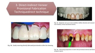 3. Direct-Indirect Veneer
Provisional Fabrication
Techniquedirect technique
 