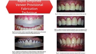 Rapid Simplified
Veneer Provisional
Fabrication
Technique
 