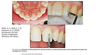 Ritter, A. V., Swift, E. J., &
Heymann, H. O. (2012).
Sturdevant's Art and
Science of Operative
Dentistry, 6th Edition.
 