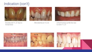 Indication (con’t)
Discoloured 11, 21 due to
incisal wear
Microdontia on 12, 22 Unharmonious smile line due
to worn 11, 21
 