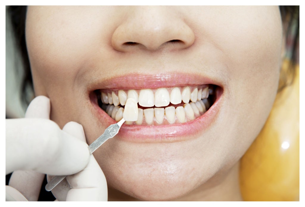 Veneers San Diego Orange Family Dental Clinic