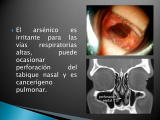    El     arsénico     es
    irritante para las
    vías     respiratorias
    altas,          puede
    ocasionar
    perforación        del
    tabique nasal y es
    cancerígeno
    pulmonar.
 