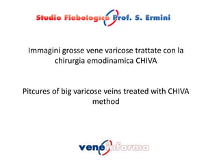 Immagini grosse vene varicose trattate con la
chirurgia emodinamica CHIVA
Pitcures of big varicose veins treated with CHIVA
method
 