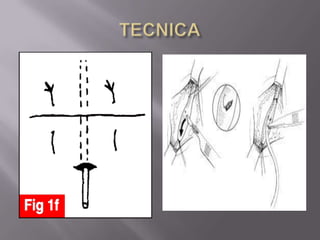 TECNICA
