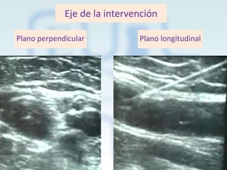 Eje de la intervención
Plano perpendicular

Plano longitudinal

 