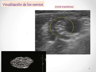 Visualización de los nervios

,

Corte transversal

 