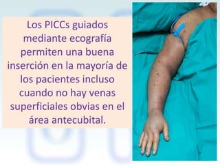 Los PICCs guiados
mediante ecografía
permiten una buena
inserción en la mayoría de
los pacientes incluso
cuando no hay venas
superficiales obvias en el
área antecubital.

 
