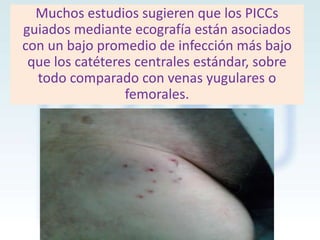 Muchos estudios sugieren que los PICCs
guiados mediante ecografía están asociados
con un bajo promedio de infección más bajo
que los catéteres centrales estándar, sobre
todo comparado con venas yugulares o
femorales.

 