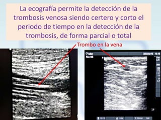 La ecografía permite la detección de la
trombosis venosa siendo certero y corto el
periodo de tiempo en la detección de la
trombosis, de forma parcial o total
Trombo en la vena

 