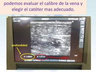 podemos evaluar el calibre de la vena y
elegir el catéter mas adecuado.

profundidad

calibre

 