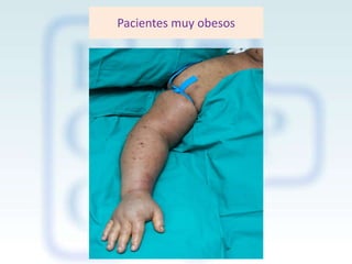 Pacientes muy obesos

 