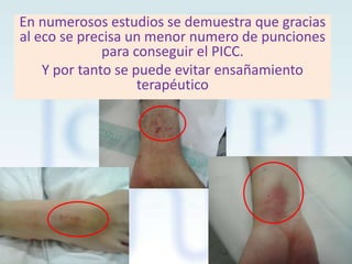 En numerosos estudios se demuestra que gracias
al eco se precisa un menor numero de punciones
para conseguir el PICC.
Y por tanto se puede evitar ensañamiento
terapéutico

 