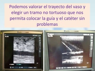 Podemos valorar el trayecto del vaso y
elegir un tramo no tortuoso que nos
permita colocar la guía y el catéter sin
problemas

 