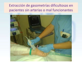 Extracción de gasometrías dificultosas en
pacientes sin arterias o mal funcionantes

 