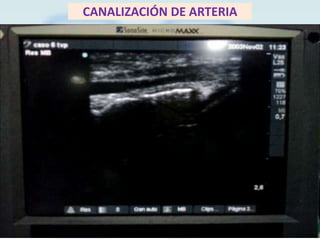 CANALIZACIÓN DE ARTERIA

 