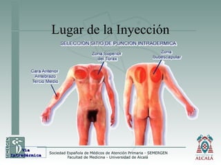 Lugar de la Inyección
VíaVía
IntradérmicaIntradérmica
 