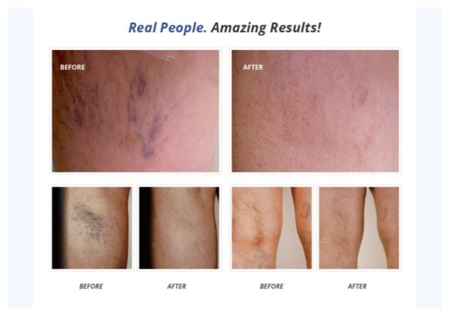 Natural Treatment For Varicose Veins In Legs In Hindi Natural Treatment For Varicose Veins In Legs In Hindi