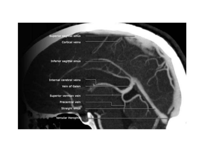 Venous Anatomy Of Brain Radiology Venous Anatomy Of Brain Radiology