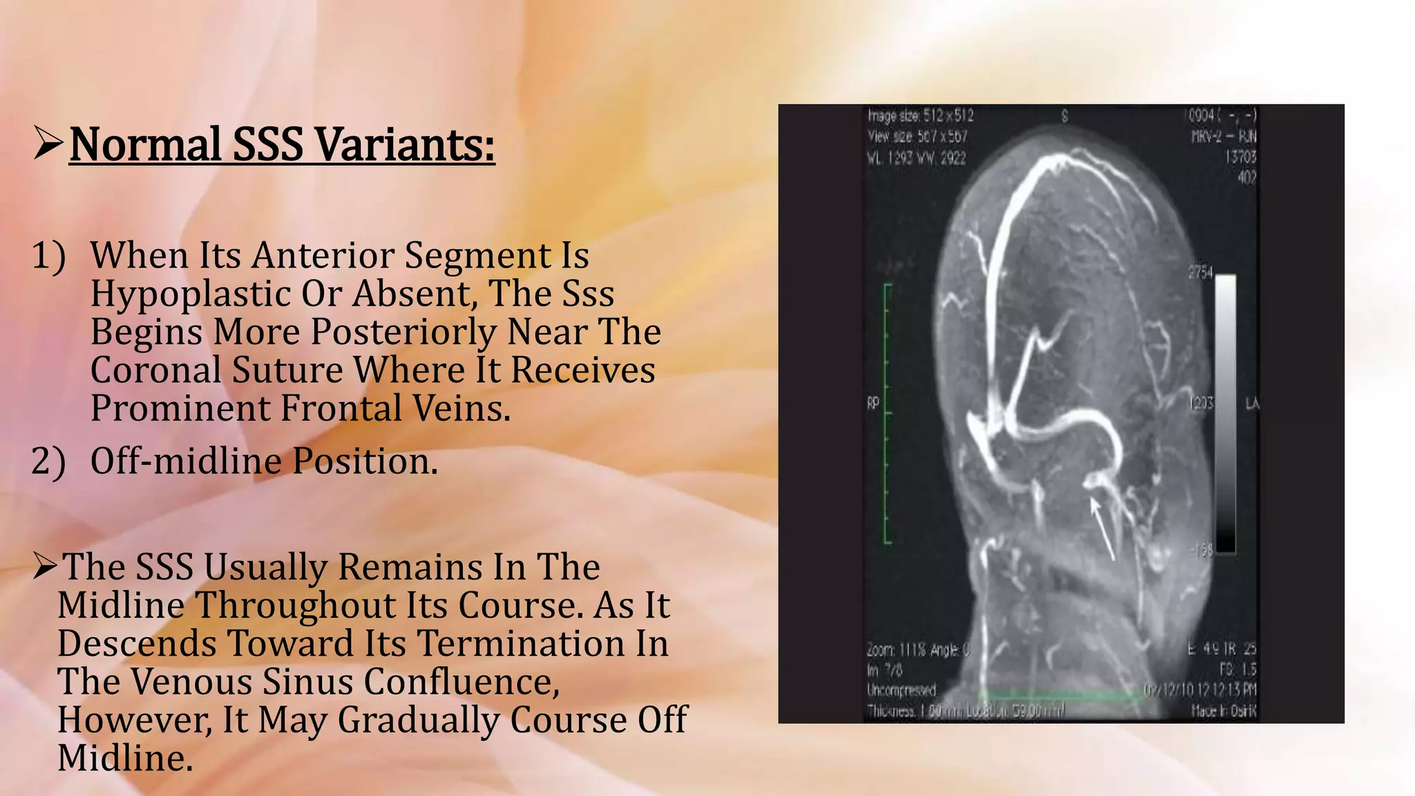 Sss Infarction Radiologic Venous Anatomy of Brain | PPTX