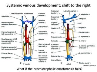 Systemic venous development: shift to the right
7 weeks Adult
L. brachiocephalic anastomosis
What if the brachiocephalic anastomosis fails?
Moore & Persaud
 