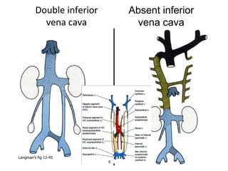 Double inferior
vena cava
Absent inferior
vena cava
Langman’s fig 12-45
 