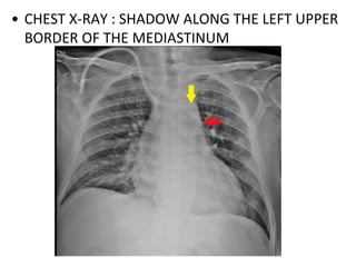 • CHEST X-RAY : SHADOW ALONG THE LEFT UPPER
BORDER OF THE MEDIASTINUM
 