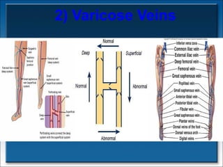 2) Varicose Veins 